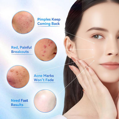 🎉🎉60% OFF This Week Promotions🔥Salicylic Acid Acne Treatment Drying Lotion